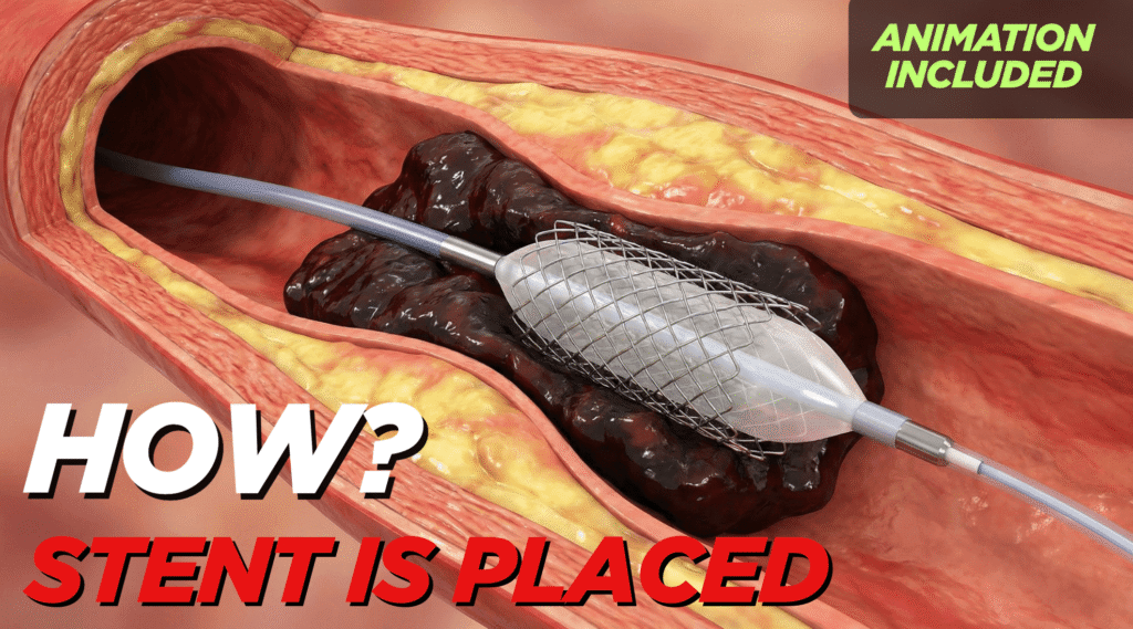 how stent is placed heart attack