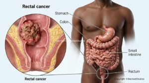 rectal cancer and early diagnosis